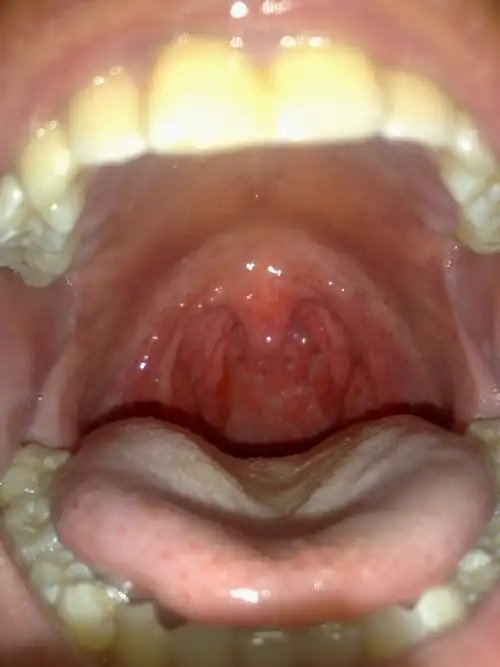 希望中医能给开服药 喉咙痛 很长时间了 声音也有