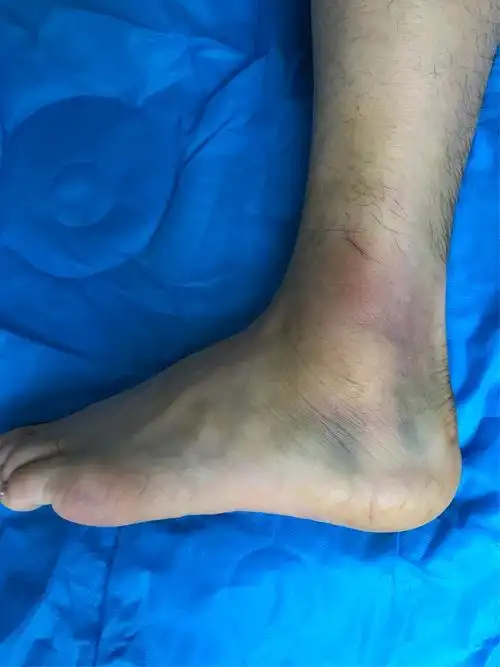 郑州市骨科医院足踝外科 王亚磊 左踝关节外侧副韧带损伤