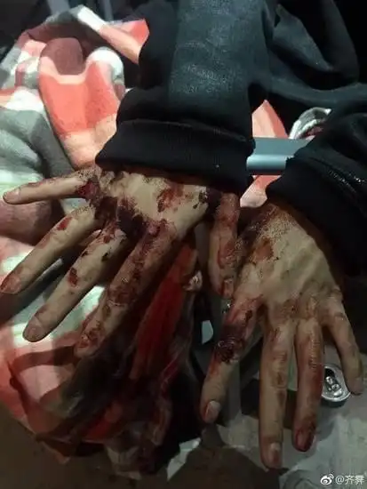 杨幂拍戏受伤全身多处划伤流血看着都心疼