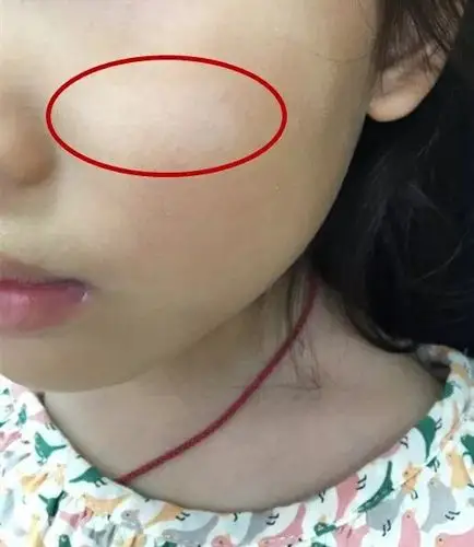 孩子脸上白斑是肚子里有虫?缺乏维生素?真相是.