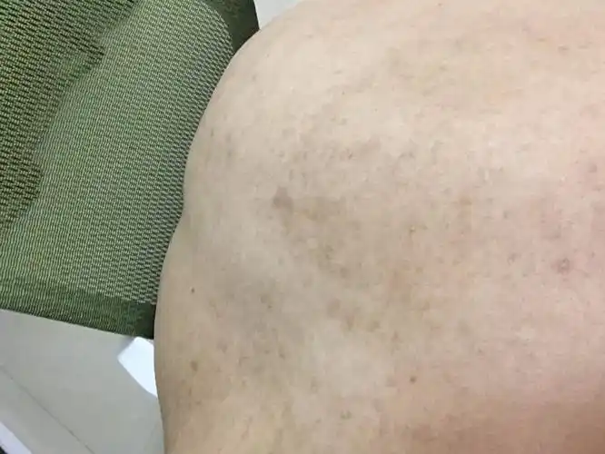 一直算是个小阴影,到底怎么样能彻底解决.