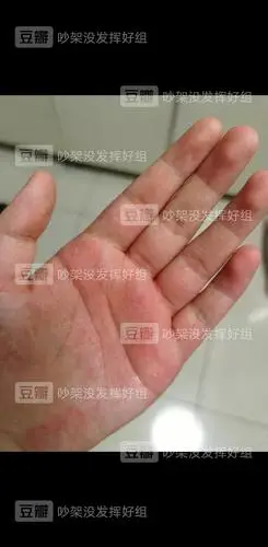 这是当时回家拍的照,我手心本身平时就比较红,但不会肿成这样.