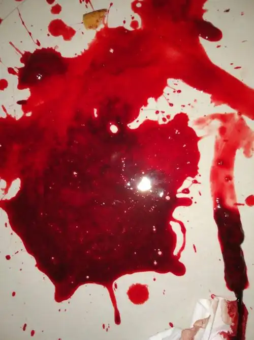 我的最后边一颗牙齿一直出血,开始时候是出血量很小,这几天出血量很大