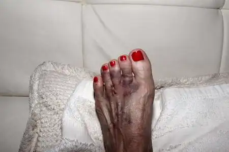 听神经瘤杭州西湖边上听神经瘤手术后的脚照片