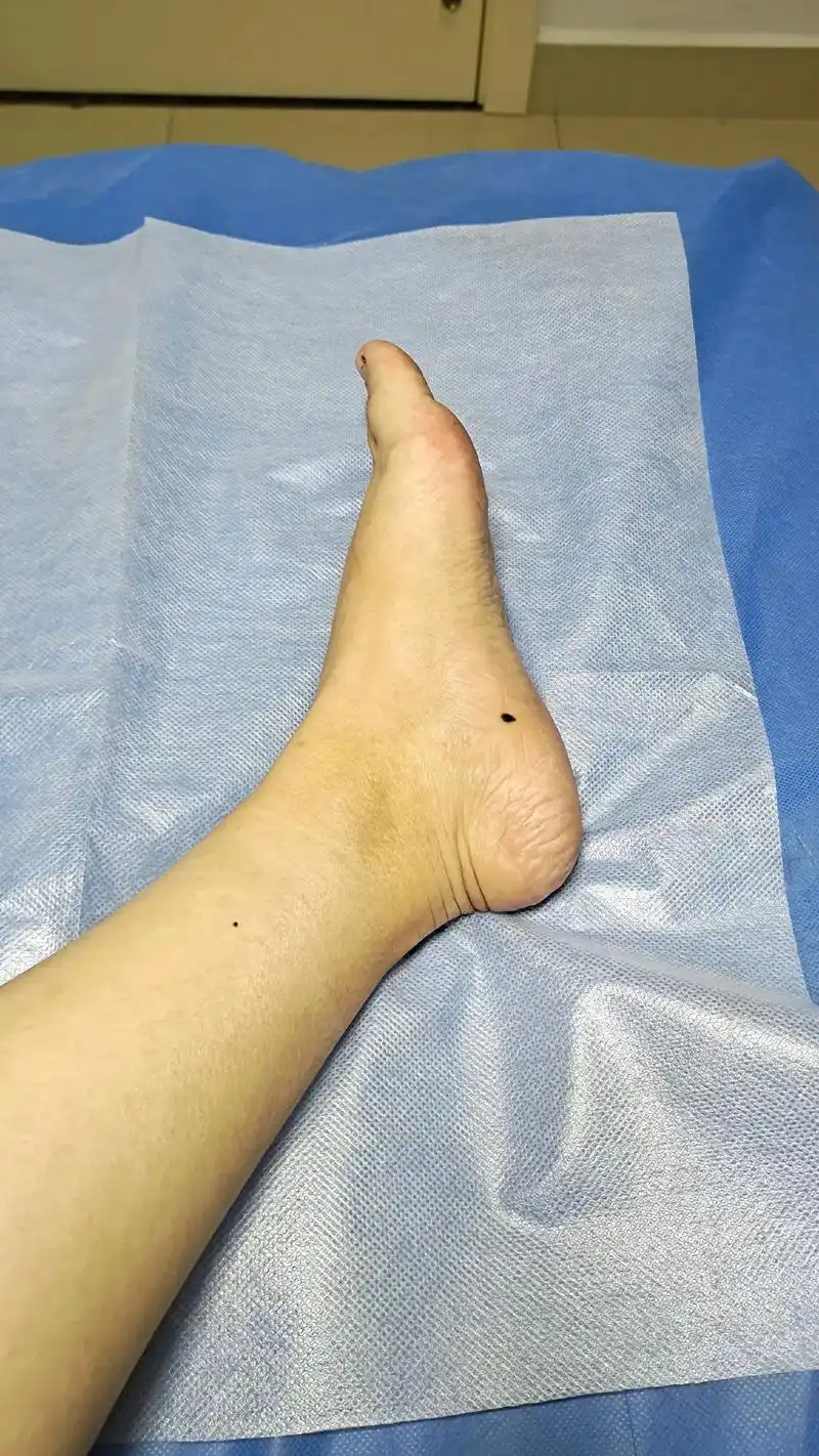 照片是我妈妈的痣破溃了,确诊恶性黑色素瘤,三级算中晚期了,治疗有点