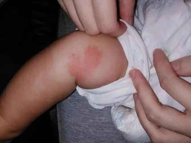 小儿腿上皮肤红色丘疹