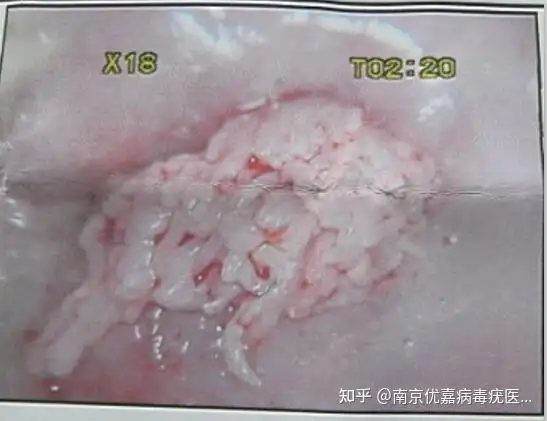 发生在人体的颈部,额头,眼睑等处,具体表现为细长的丝状外观,顶端尖锐