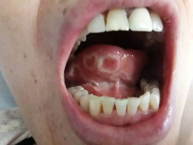 这是什么类型的口腔溃疡?