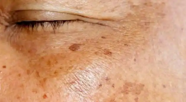 老年斑是人体衰老后皮肤代谢减退,局部色素沉着,属于正常的生理现象