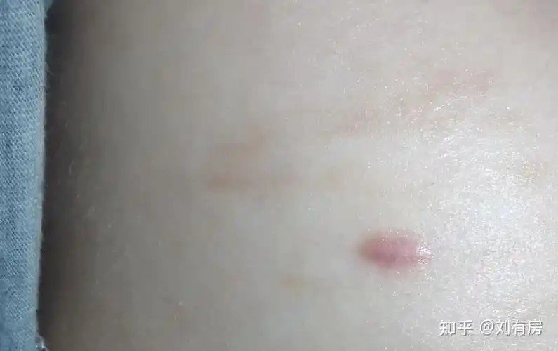 广州中山二院乳腺纤维瘤微创记录