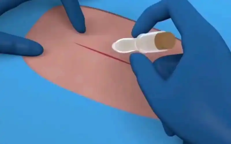 "黑科技"胶水,60秒粘合伤口,有效缩短愈合时间 !