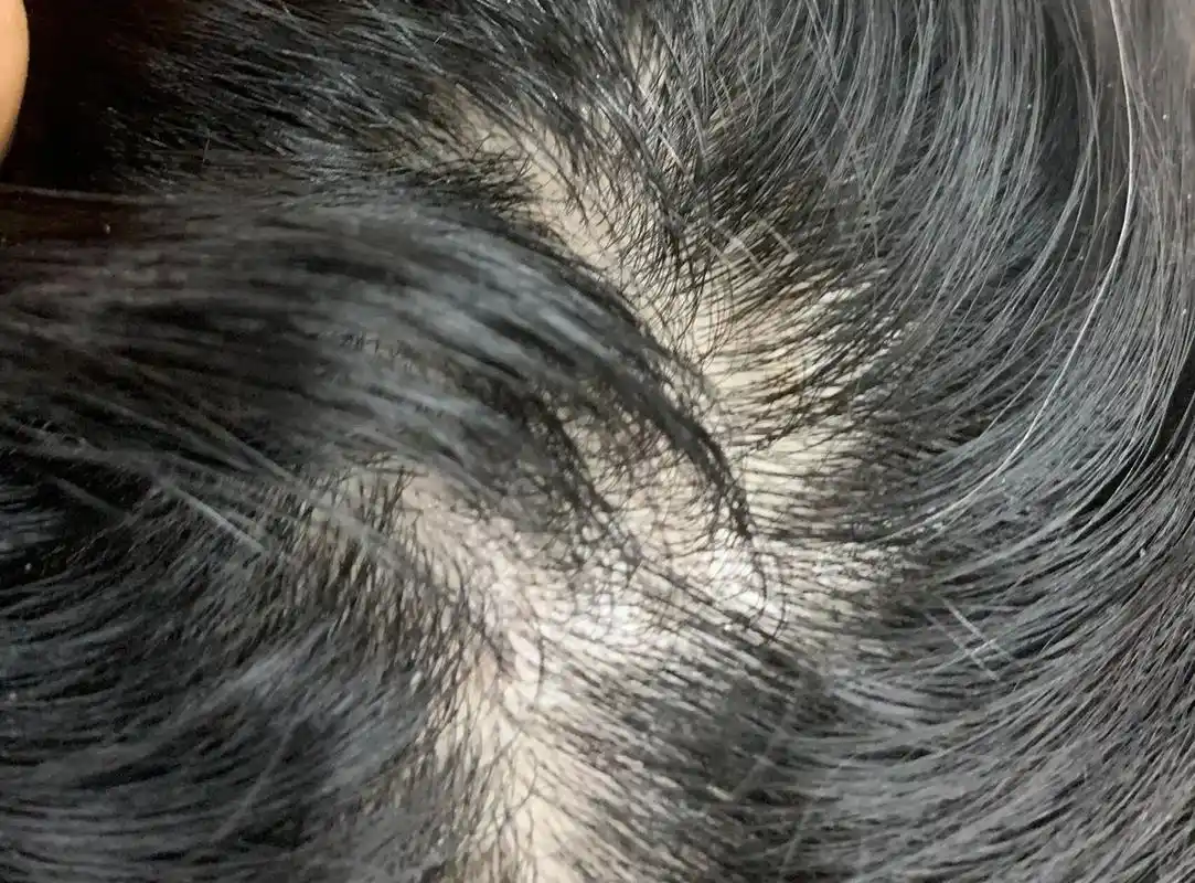 最近发现头顶有个凹陷 不知道怎么回事 最近摸到头顶有个凹陷.