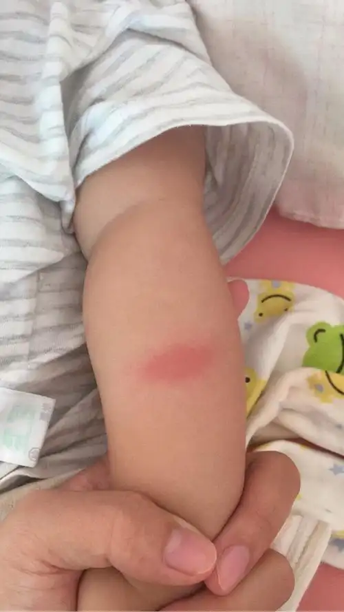 宝宝被蚊子咬后又红又肿最后还变黑色斑