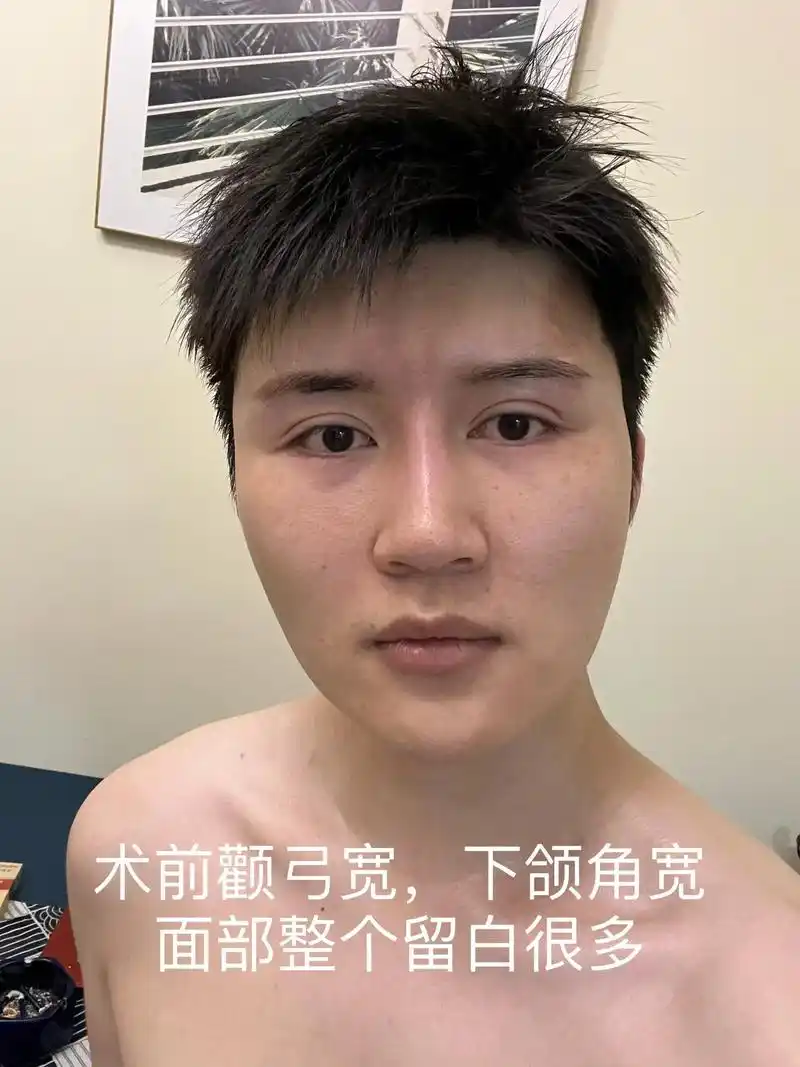 磨骨分享 项目:双眼第五次修复加颧骨内推下颌角长曲线 手术时 - 抖音