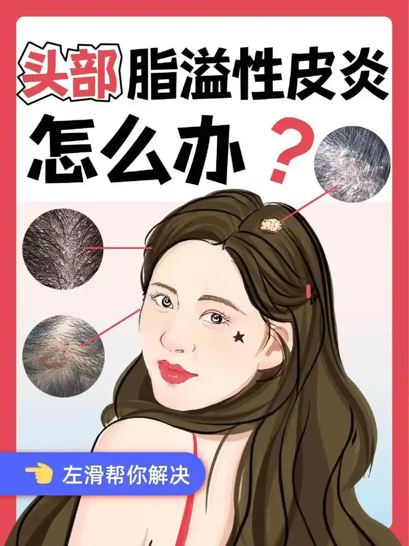 3招教你改善脂溢性皮炎.16615注意生活饮食  - 抖音