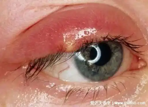 麦粒肿早期图片,会出现红肿热痛(包括内麦粒肿和外麦粒肿)_七七号养生