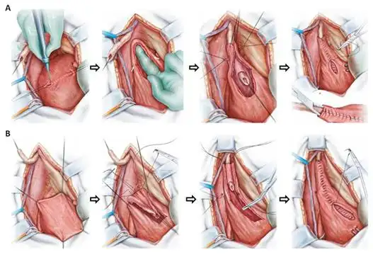 输尿管膀胱重建术在妇科肿瘤手术中的应用_宫颈癌_宫颈癌治疗方式
