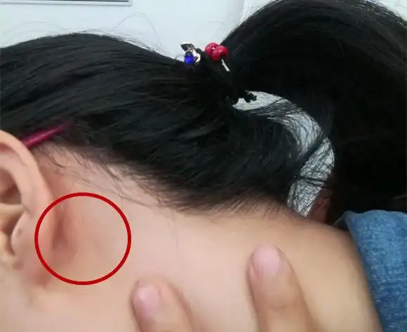 溶血性链球菌这种情况就会引起淋巴结发炎,然后淋巴细胞就会奋起反击