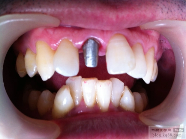 前牙烤瓷桩冠———东海牙医郑志成