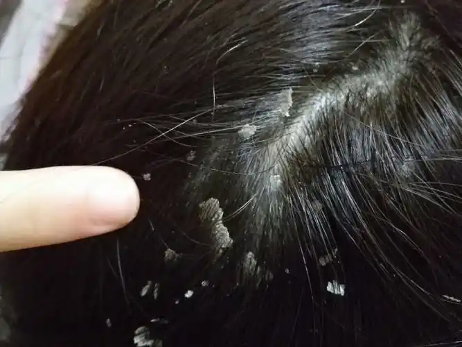 头皮屑多是一种怎样的体验