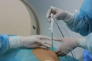 心脏导管射频消融术,术前术后讲解都在这里了!