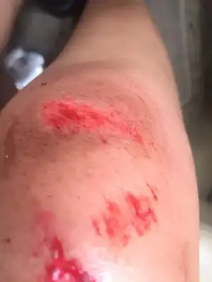 摔伤了,女性朋友问我怎么弄得,该怎么风趣回答