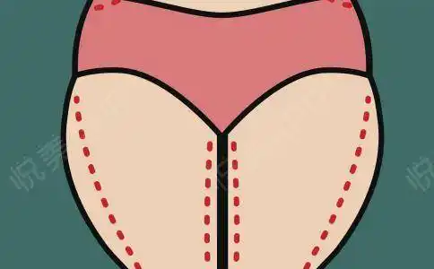 开课啦大腿脂肪堆积显著影响体型美怎么办