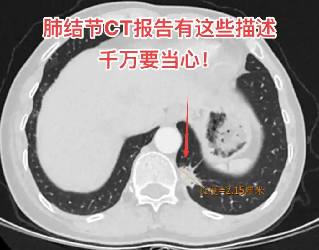 肺结节ct报告有这些描述千万要当心!1.分叶和毛刺;2.空泡 - 抖音