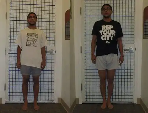 山姆2015年接受手术,身高从162变为170