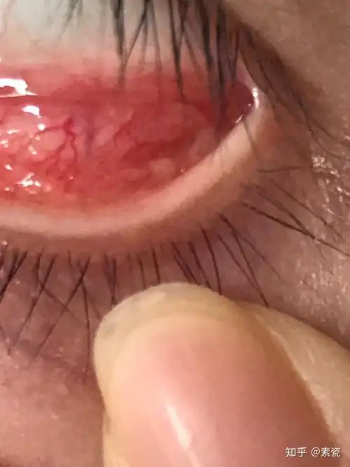 滤泡性结膜炎如何能有效治疗之前会怕光流眼泪眼干涩疼痛现在这些症状