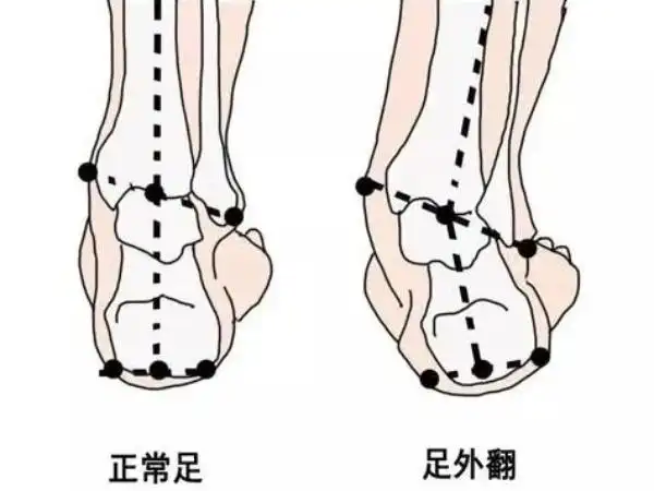 宝宝足外翻和正常足有哪些区别有图片分享吗