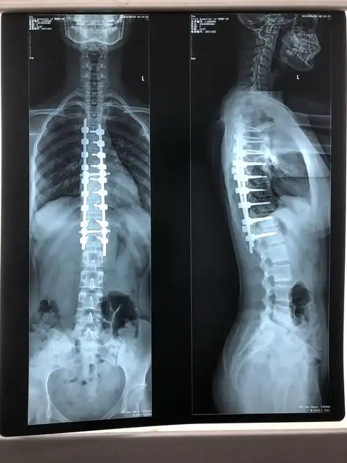 特发性脊柱侧弯的治疗!附手术前后对比照片! - 好大夫在线