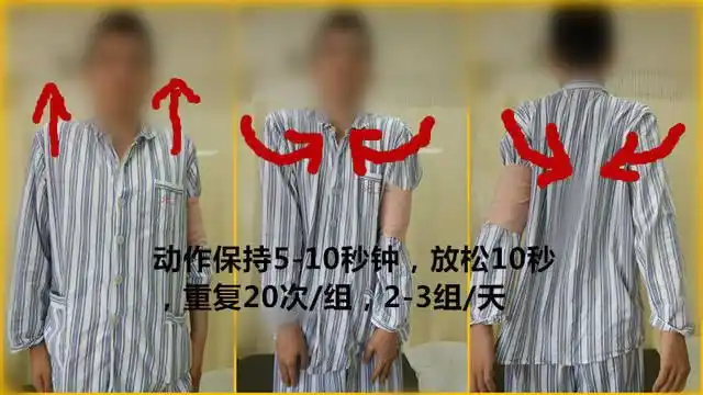 锁骨骨折术后康复