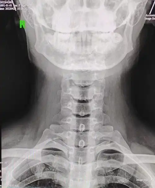 甘草学园 | 年轻人颈痛头昏目懵s型颈椎错位案