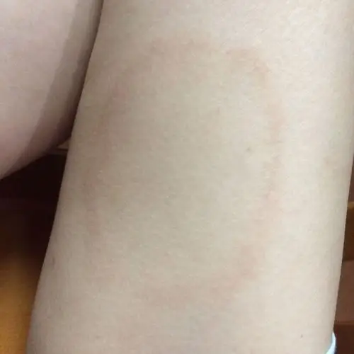 大腿上有一大片红色圈,不知道是过敏还是什么?这是什么?