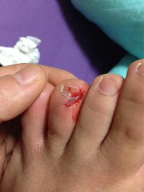 一脚踢门上就这样了,当时以为脚趾断了,都疼哭了.