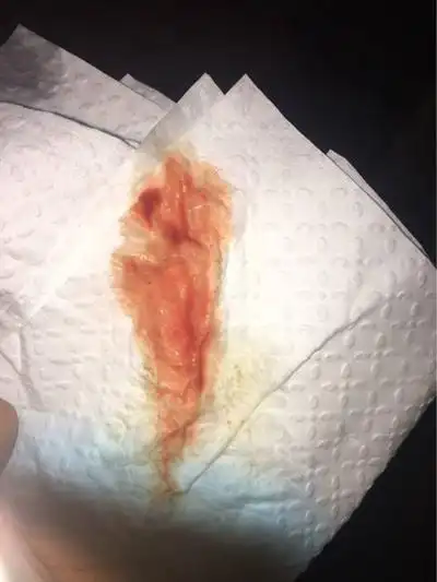 先兆流产图片_先兆流产症状表现图片大全_有来医生