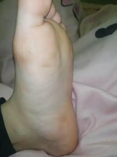 脚上长白色洞洞