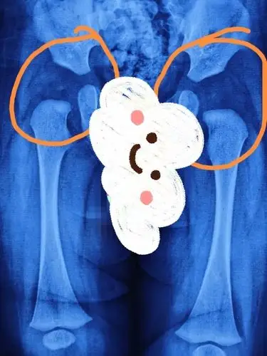 臀纹不对称,不一定是髋关节发育不良!