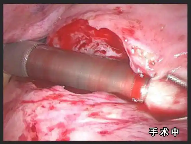 子宫肌瘤图片_子宫肌瘤症状表现图片大全_有来医生