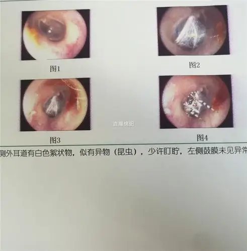 瑟瑟发抖蜘蛛结网在人耳耳鸣发痒刺痛大闹盘丝洞