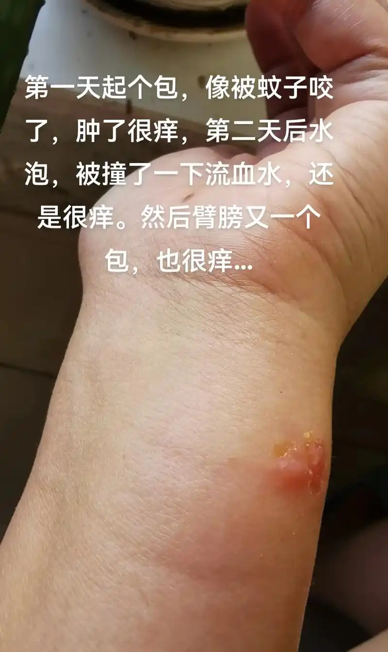 第一天起个包,像被蚊子咬了,肿了很痒,第二天后水泡,被撞了一 - 抖音
