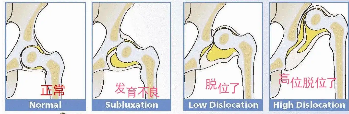 先天性髋关节脱位_疾病介绍_治疗方法 - 好大夫在线