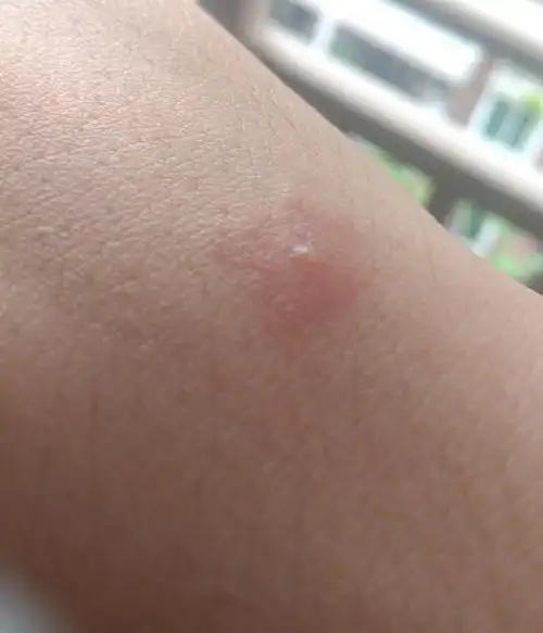 这个是什么被什么虫子咬了,周围红肿,中间有一颗水泡.有点痒.