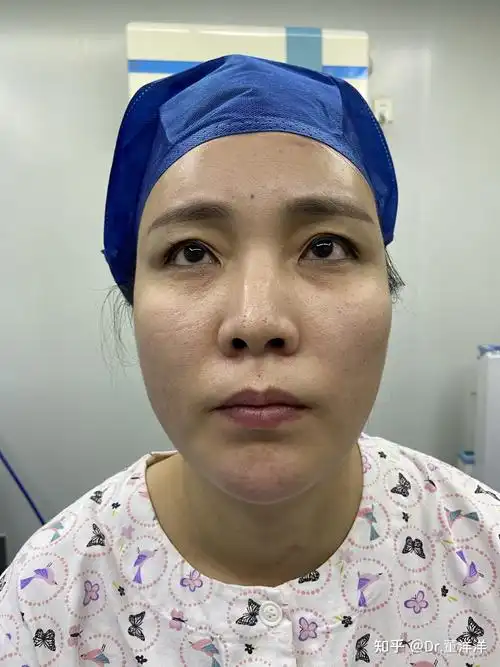 案例分析:顾客是由于外伤造成的鼻骨骨折歪斜,鼻背还有些轻微增生