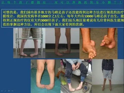 儿童先天性畸形之马蹄内翻足 - 好大夫在线