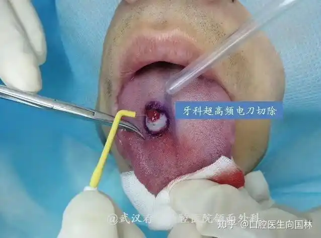 舌头上长疙瘩超高频电刀轻松切除舌背肿物