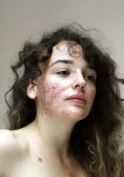 她们满脸吓人的痤疮,红斑,痘痘,却选择勇敢面对素颜_网易订阅
