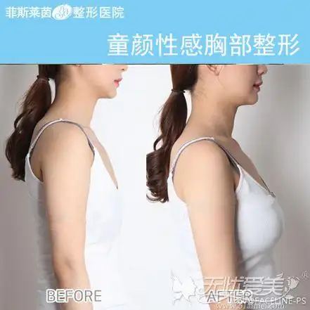 隆胸术后这样做可以缩短恢复期 不然6万多就白花了-韩国菲斯莱茵整形