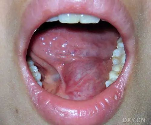 【病例讨论】舌下腺囊肿 [病例帖]